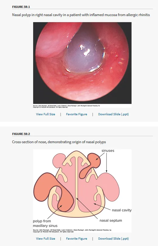 Nasal polyps