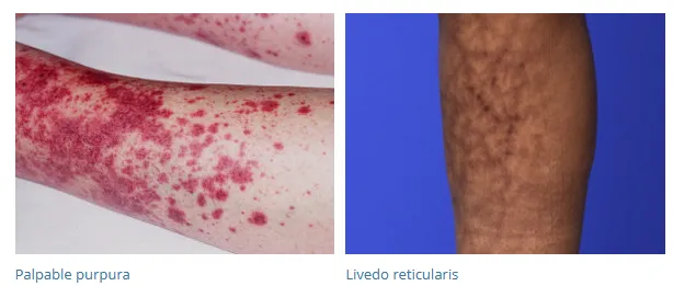 Palpable purpura and livedo reticularis in polyarteritis nodosa