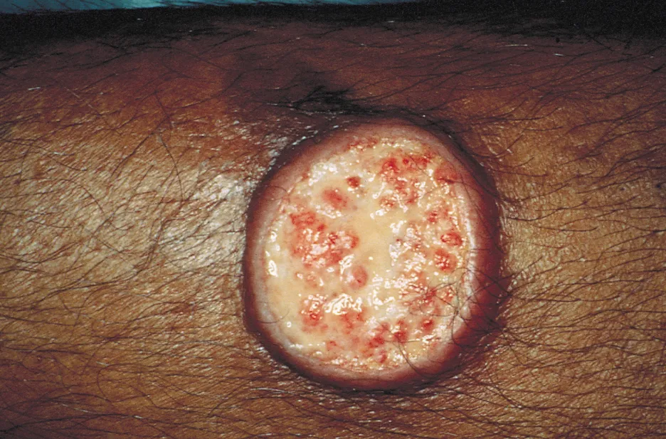 Cutaneous leishmaniasis