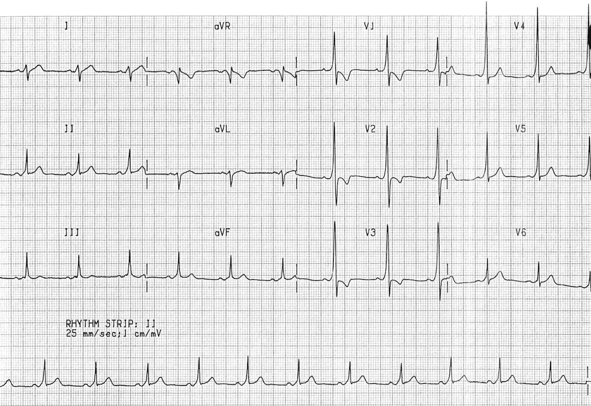 WPW ECG — short PR interval and delta wave (slurred QRS upstroke)