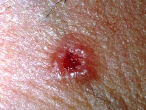 Nodular BCC