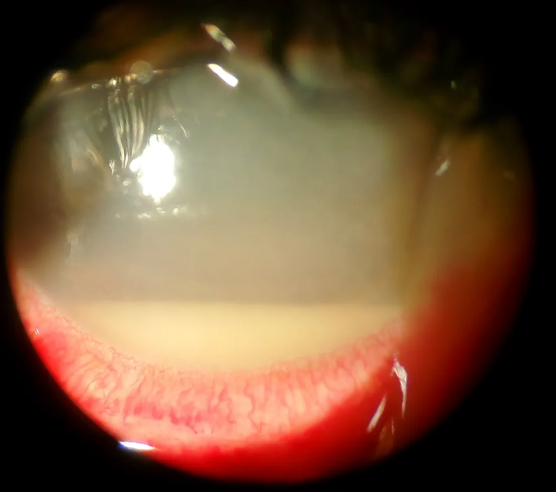 Hypopyon with hazy media