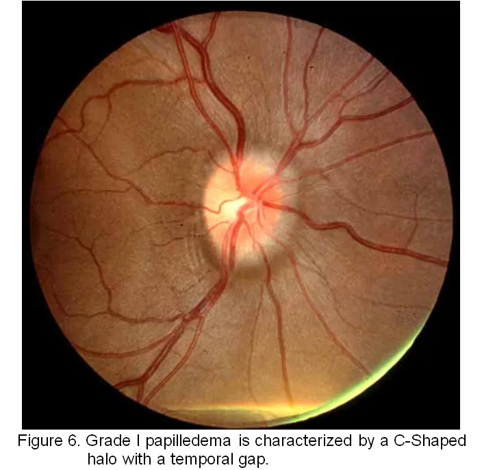 Papilloedema grading