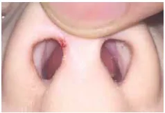 Septal haematoma