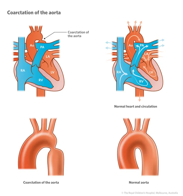 Coarctation of the aorta