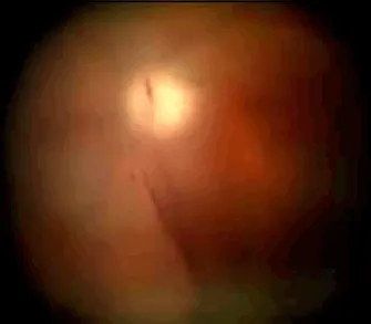 Vitreous haemorrhage associated with posterior vitreous detachment