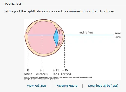 Cataract