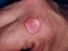 Localised granuloma annulare