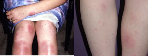 Erythema nodosum