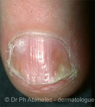 Nail psoriasis