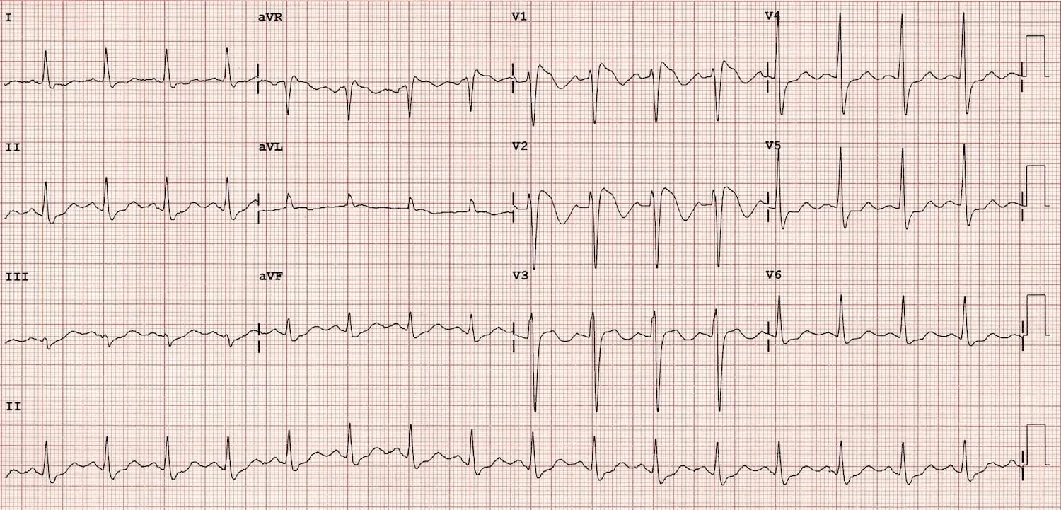 ECG example — deep T-wave inversion