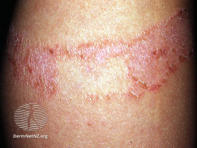 Sticking-plaster rash