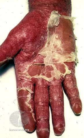 Erythrodermic psoriasis