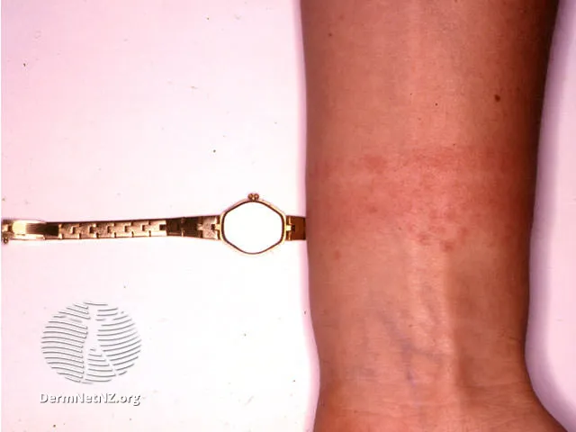 Watch-strap contact allergy