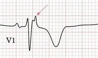 Epsilon waves