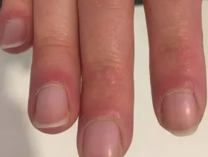 Dermatomyositis of the nailfold
