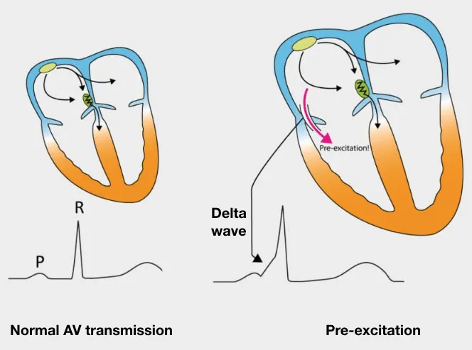WPW — delta wave pre-excitation