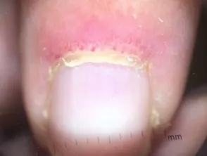 Dermatomyositis of the nailfold