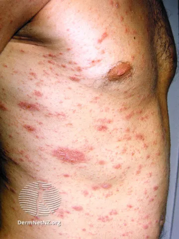 Secondary rash