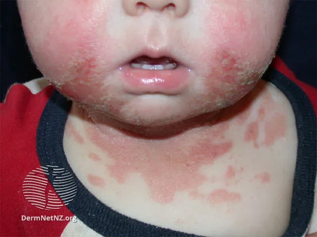 Irritant dermatitis (saliva)
