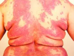 Generalised pustular psoriasis