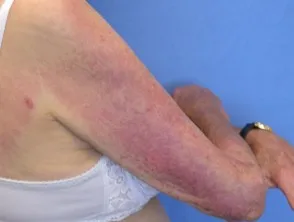 Dermatomyositis