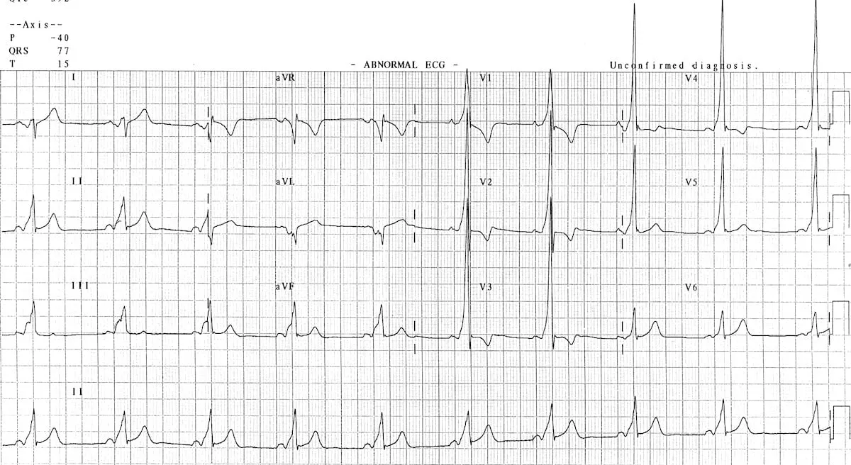 Type A WPW ECG
