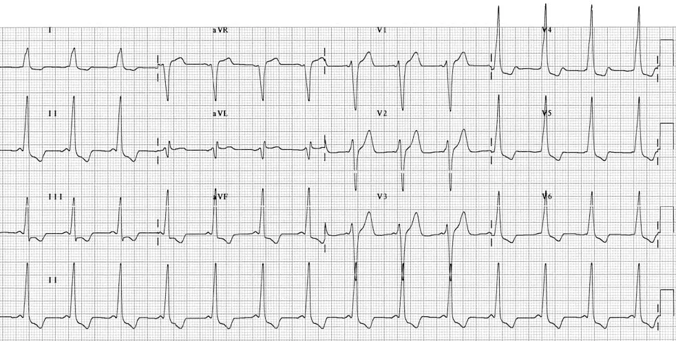ECG example
