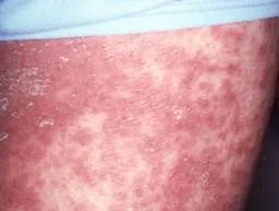 Generalised pustular psoriasis