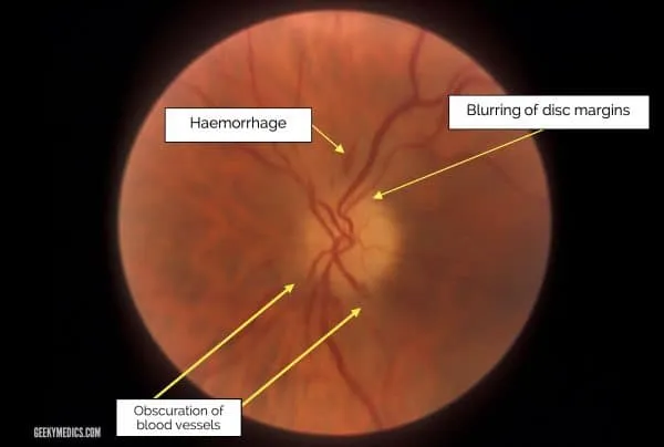 Papilloedema