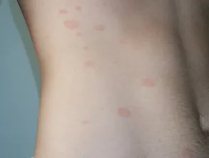 Pityriasis rosea