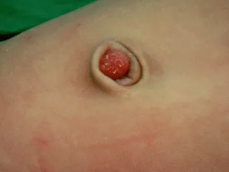 Umbilical granuloma
