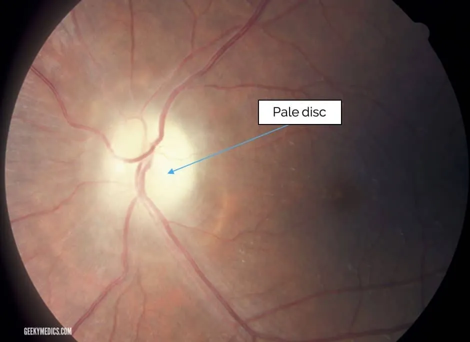 Optic nerve atrophy — pale optic disc