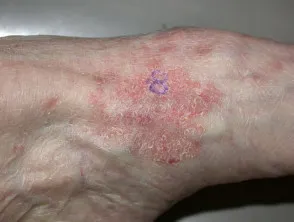 Bowen disease