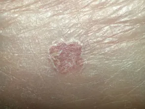 Bowen disease