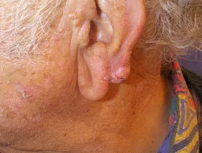 Facial SCC