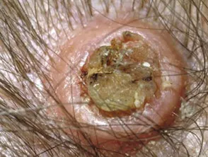 Keratoacanthoma