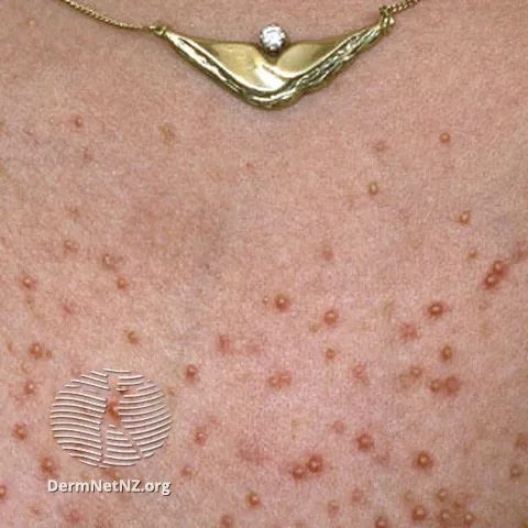 Folliculitis