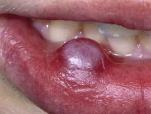 Oral lesion
