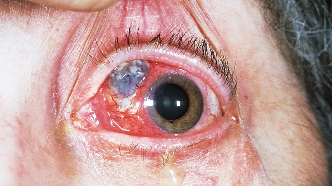Necrotising scleritis — conjunctival ulceration with scleral necrosis; the blue-grey area is exposed choroid where sclera has thinned/lost