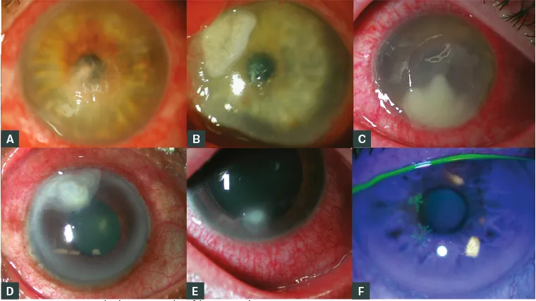 Slit lamp photomicrographs of keratitis: (a–c) bacterial, (d,e) fungal, (f) herpes simplex
