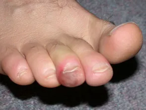 Perniosis