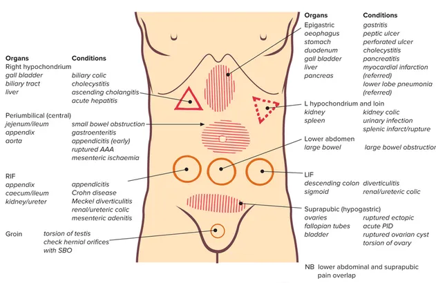 Typical sites of various causes of abdominal pain