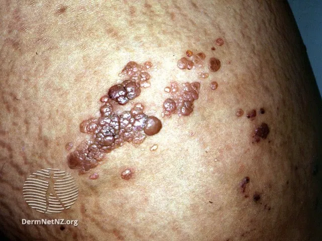 Lymphangioma