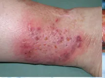 Pyoderma gangrenosum