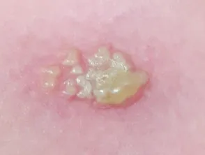 Herpes simplex vesicles