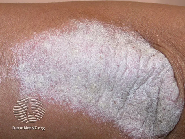 Psoriasis