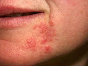 Perioral dermatitis