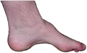 Charcot-Marie-Tooth disease foot deformity