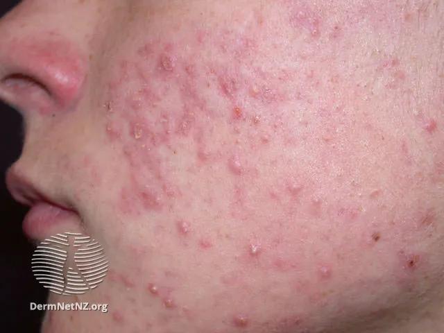 Acne vulgaris